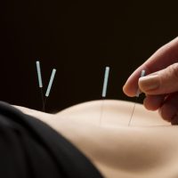 acupuncture treatment on a person's back
