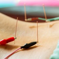 person receiving electro acupuncture treatment