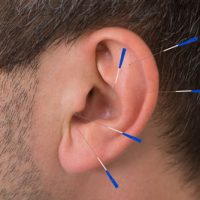 person receiving auricular acupuncture